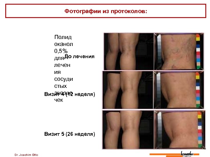 Фотографии из протоколов: Полид оканол 0, 5% До для лечения лечен ия сосуди стых