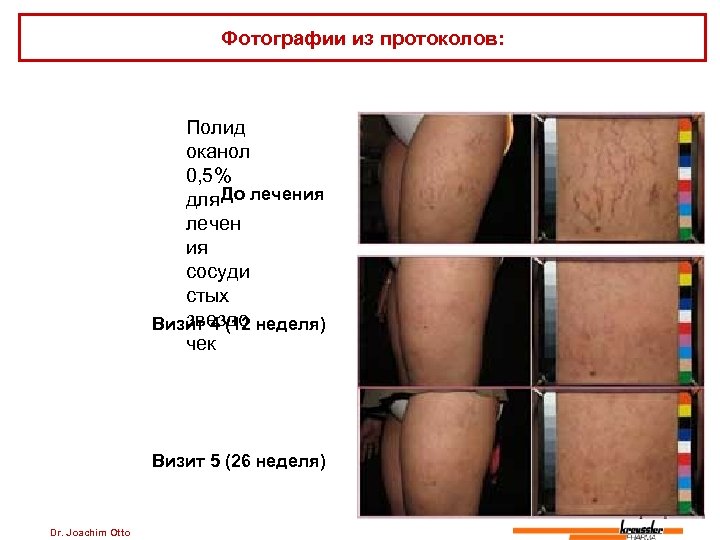 Фотографии из протоколов: Полид оканол 0, 5% До для лечения лечен ия сосуди стых