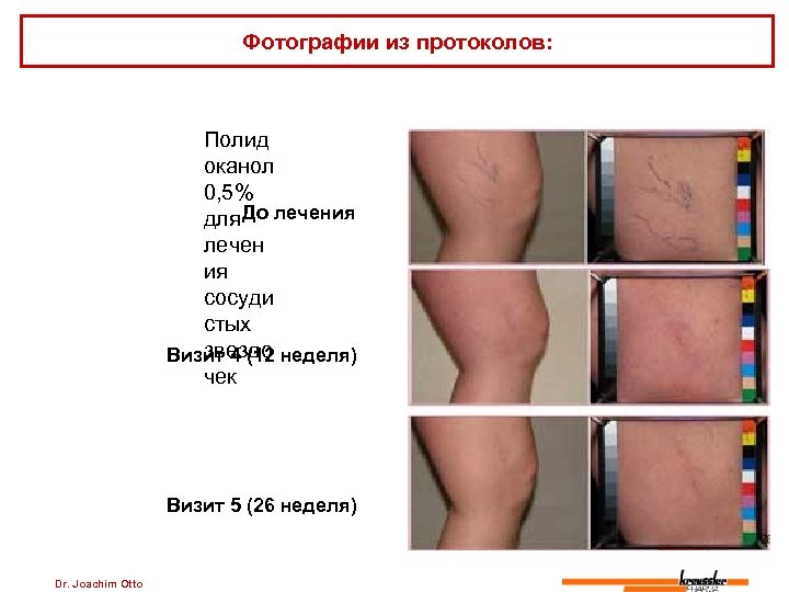 Фотографии из протоколов: Полид оканол 0, 5% До для лечения лечен ия сосуди стых