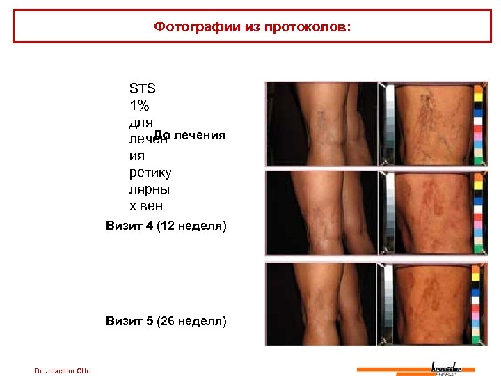 Фотографии из протоколов: STS 1% для До лечения ия ретику лярны х вен Визит