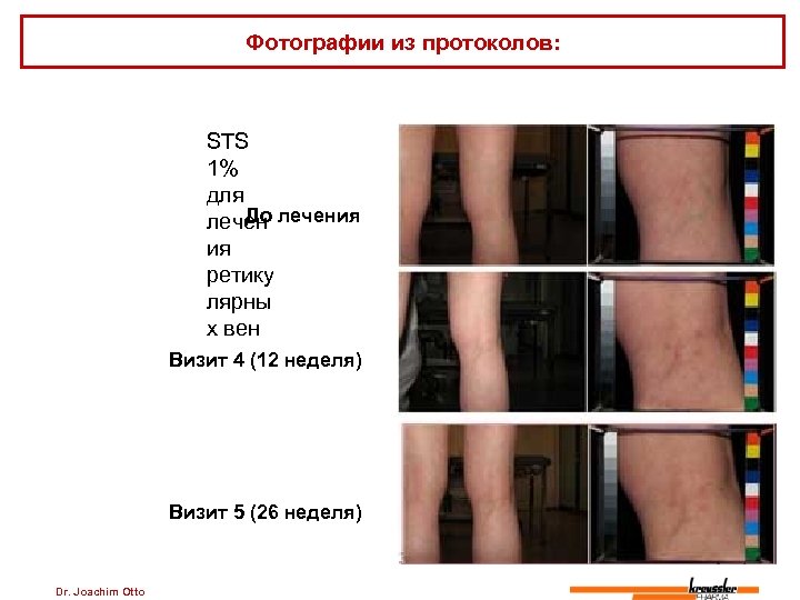 Фотографии из протоколов: STS 1% для До лечения ия ретику лярны х вен Визит