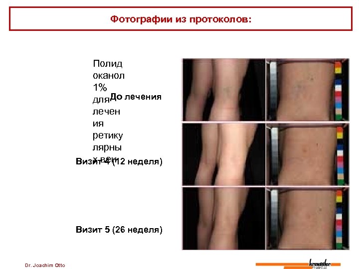 Фотографии из протоколов: Полид оканол 1% До для лечения лечен ия ретику лярны х