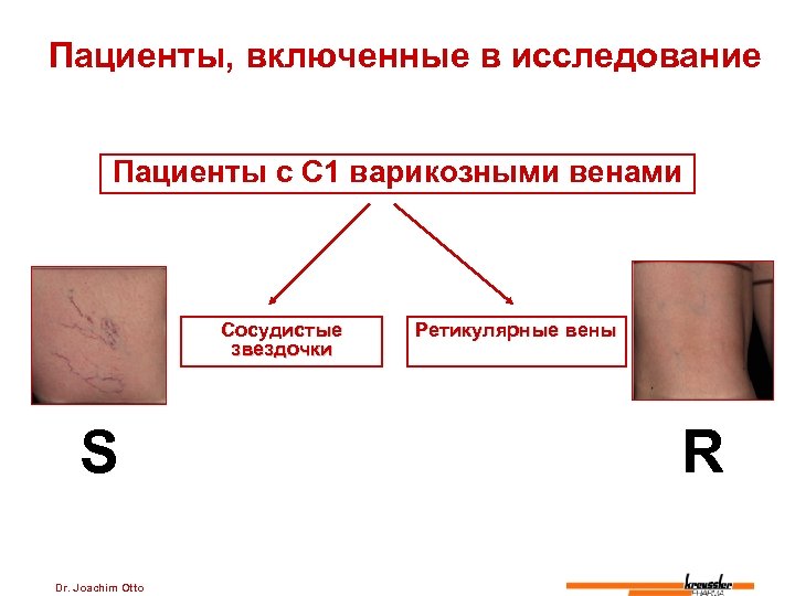 Пациенты, включенные в исследование Пациенты с C 1 варикозными венами Сосудистые звездочки S Dr.