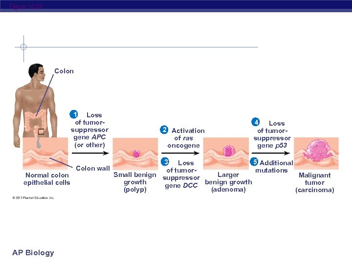 Figure 18. 25 Colon 1 Loss of tumorsuppressor gene APC (or other) Normal colon