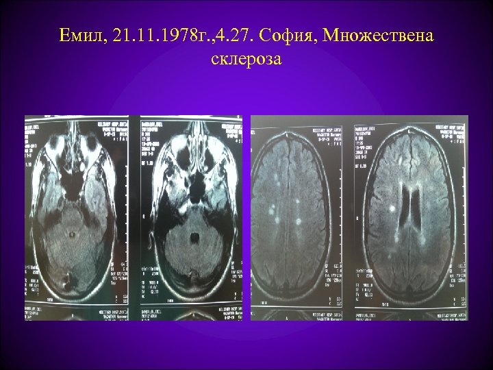 Емил, 21. 1978 г. , 4. 27. София, Множествена склероза 