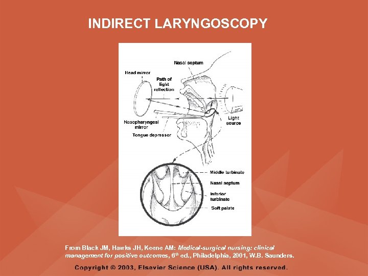 INDIRECT LARYNGOSCOPY From Black JM, Hawks JH, Keene AM: Medical-surgical nursing: clinical management for