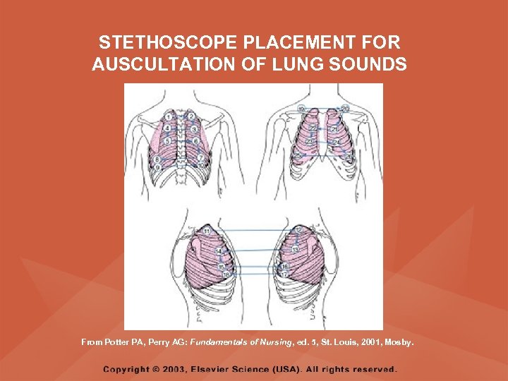STETHOSCOPE PLACEMENT FOR AUSCULTATION OF LUNG SOUNDS From Potter PA, Perry AG: Fundamentals of