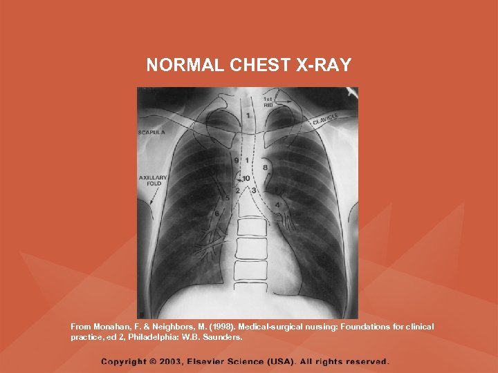 NORMAL CHEST X-RAY From Monahan, F. & Neighbors, M. (1998). Medical-surgical nursing: Foundations for