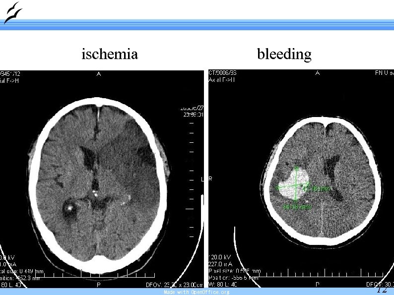 ischemia bleeding Made with Open. Office. org 12 