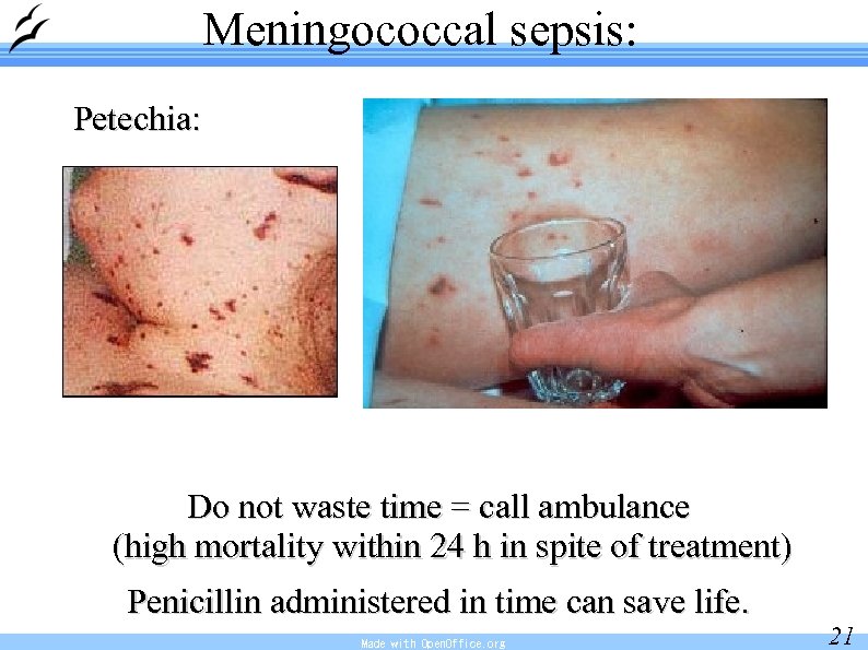 Meningococcal sepsis: Petechia: Do not waste time = call ambulance (high mortality within 24
