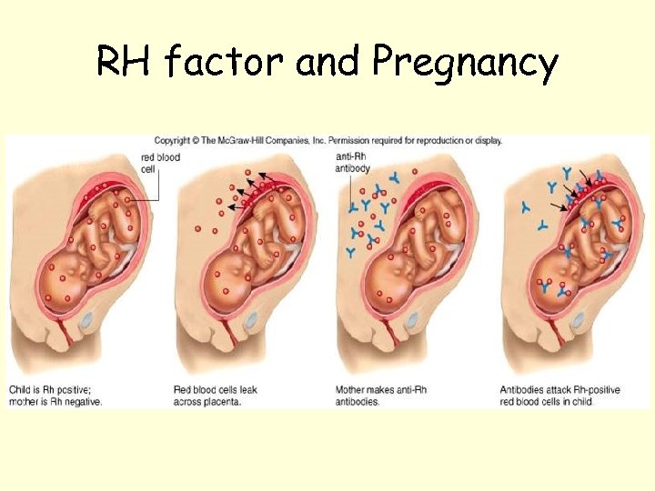 RH factor and Pregnancy 