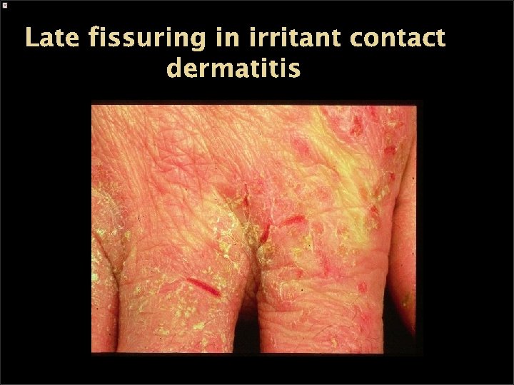 Late fissuring in irritant contact dermatitis 