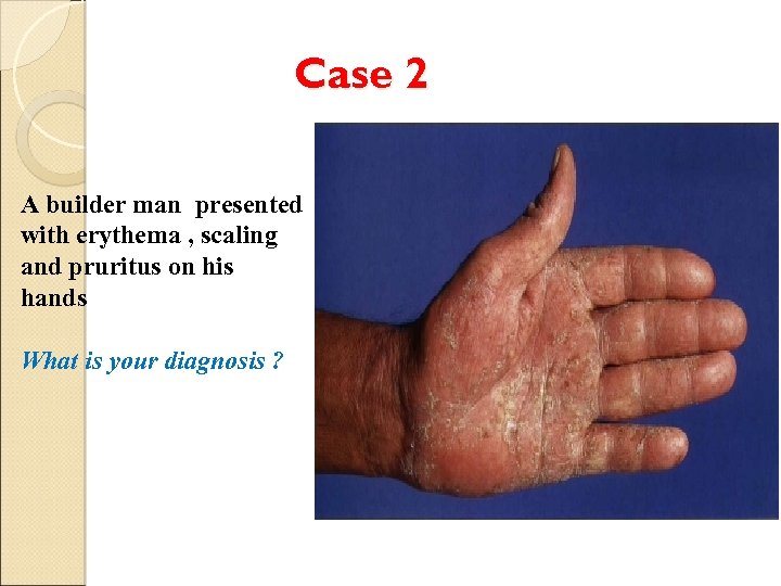 Case 2 A builder man presented with erythema , scaling and pruritus on his