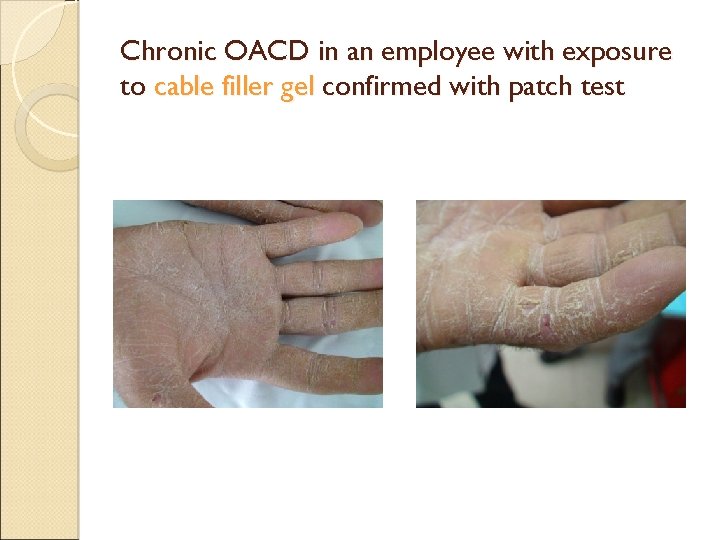 Chronic OACD in an employee with exposure to cable filler gel confirmed with patch