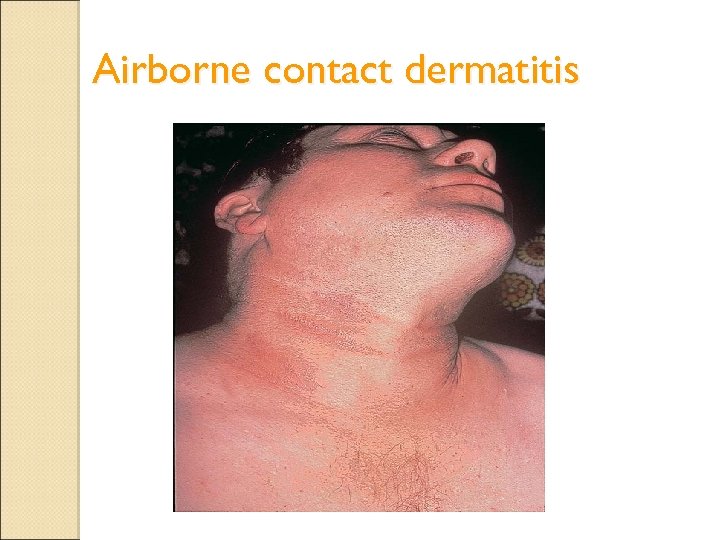 Airborne contact dermatitis 