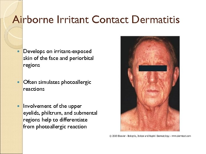 Airborne Irritant Contact Dermatitis Develops on irritant-exposed skin of the face and periorbital regions