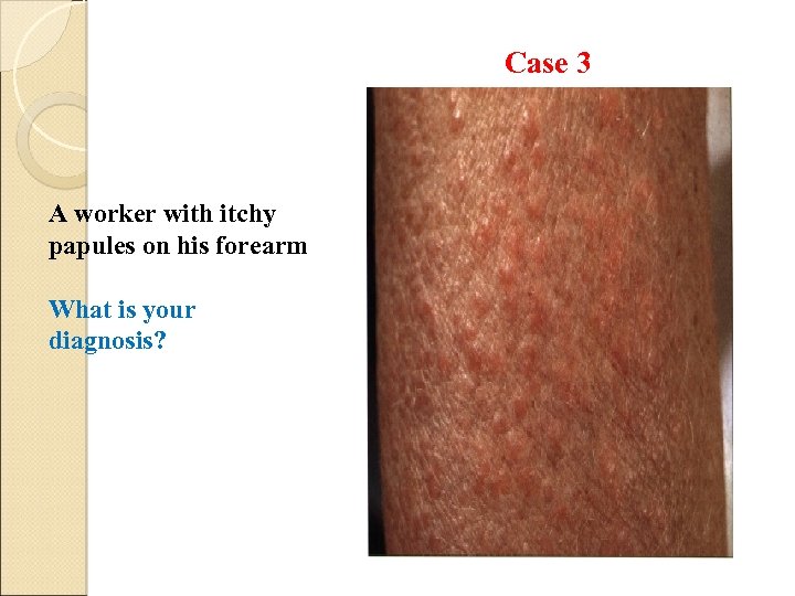 Case 3 A worker with itchy papules on his forearm What is your diagnosis?