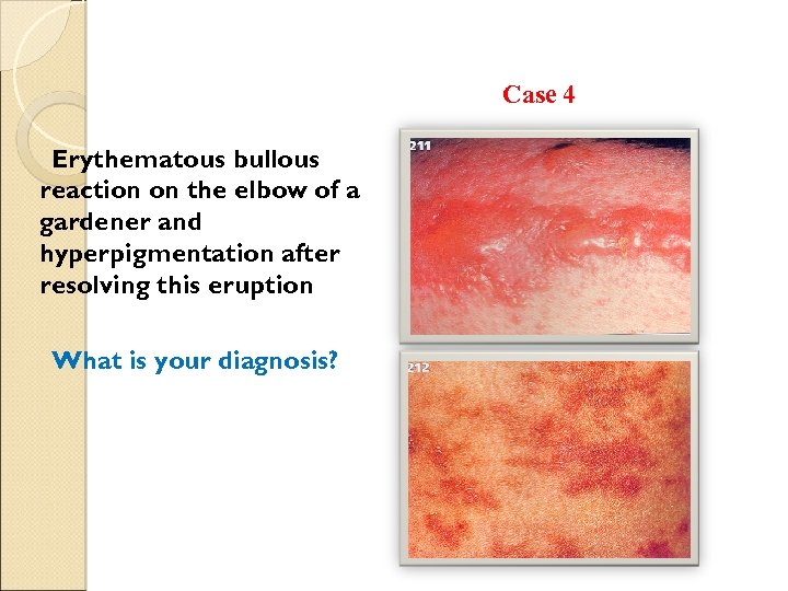 Case 4 Erythematous bullous reaction on the elbow of a gardener and hyperpigmentation after