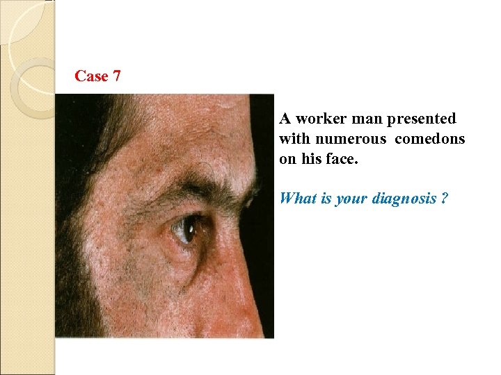 Case 7 A worker man presented with numerous comedons on his face. What is