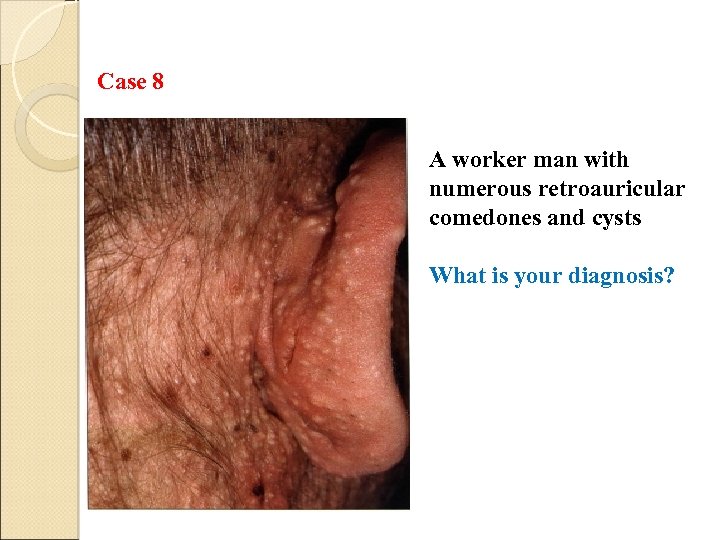 Case 8 A worker man with numerous retroauricular comedones and cysts What is your