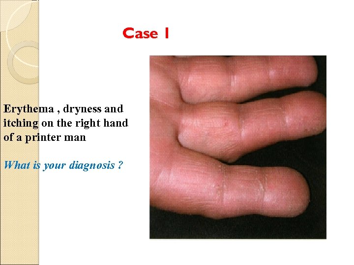 Case 1 Erythema , dryness and itching on the right hand of a printer