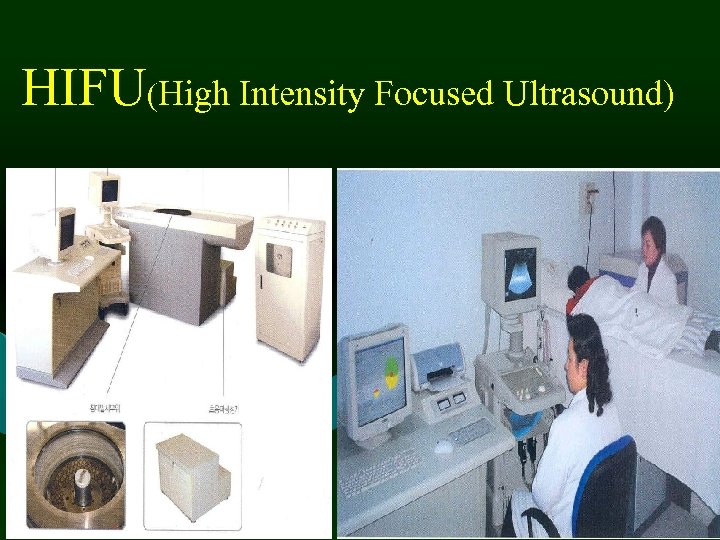 HIFU(High Intensity Focused Ultrasound) 