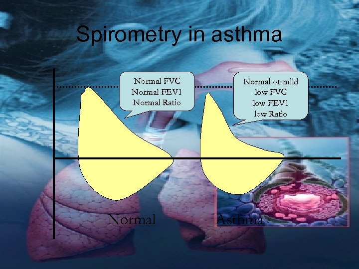 Spirometry in asthma Normal FVC Normal FEV 1 Normal Ratio Normal or mild low