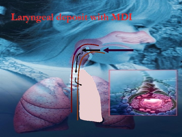 Laryngeal deposit with MDI 