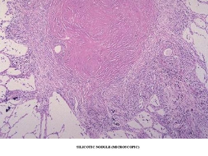 SILICOTIC NODULE (MICROSCOPIC) 