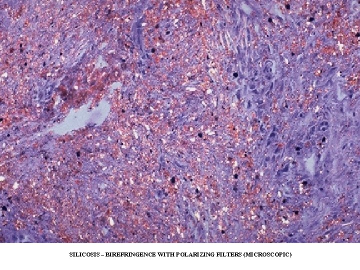 SILICOSIS – BIREFRINGENCE WITH POLARIZING FILTERS (MICROSCOPIC) 