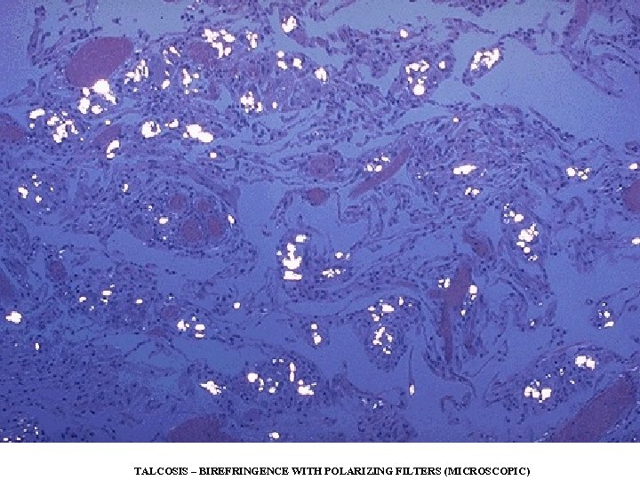 TALCOSIS – BIREFRINGENCE WITH POLARIZING FILTERS (MICROSCOPIC) 