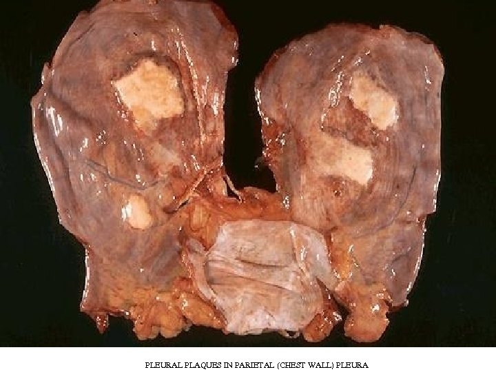 PLEURAL PLAQUES IN PARIETAL (CHEST WALL) PLEURA 