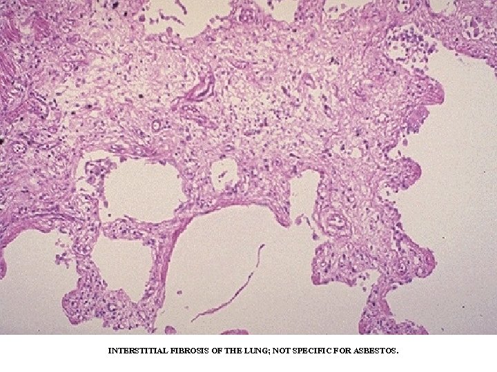 INTERSTITIAL FIBROSIS OF THE LUNG; NOT SPECIFIC FOR ASBESTOS. 
