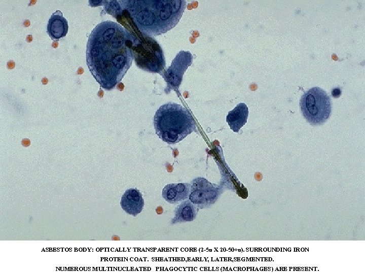 ASBESTOS BODY: OPTICALLY TRANSPARENT CORE (2 -5 u X 20 -50+u). SURROUNDING IRON PROTEIN