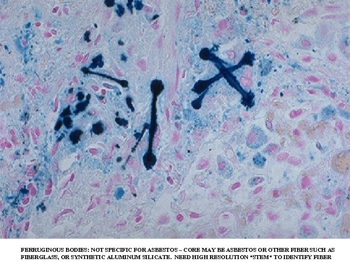 FERRUGINOUS BODIES: NOT SPECIFIC FOR ASBESTOS – CORE MAY BE ASBESTOS OR OTHER FIBER