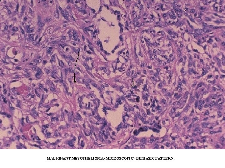 MALIGNANT MESOTHELIOMA (MICROSCOPIC). BIPHASIC PATTERN. 