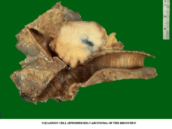 SQUAMOUS CELL (EPIDERMOID) CARCINOMA OF THE BRONCHUS 