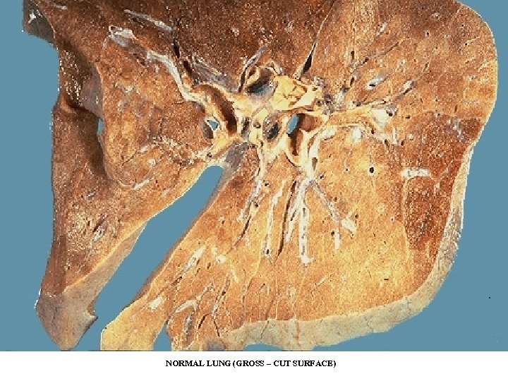 NORMAL LUNG (GROSS – CUT SURFACE) 