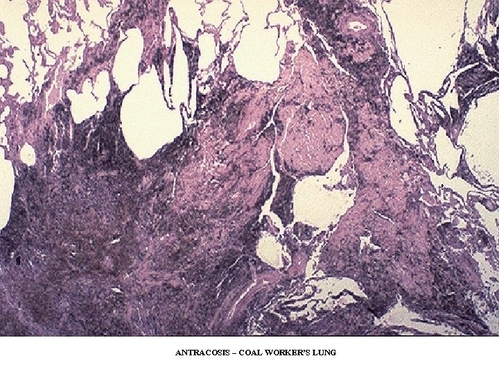 ANTRACOSIS – COAL WORKER’S LUNG 