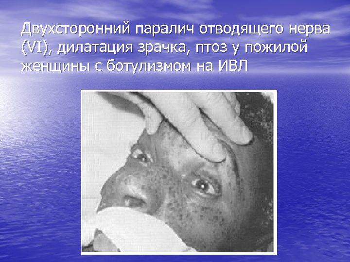 Двухсторонний паралич отводящего нерва (VI), дилатация зрачка, птоз у пожилой женщины с ботулизмом на
