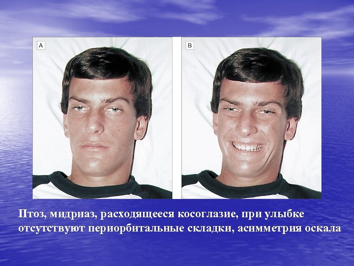 Птоз, мидриаз, расходящееся косоглазие, при улыбке отсутствуют периорбитальные складки, асимметрия оскала 