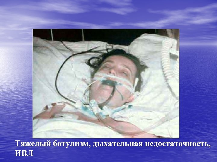 Тяжелый ботулизм, дыхательная недостаточность, ИВЛ 