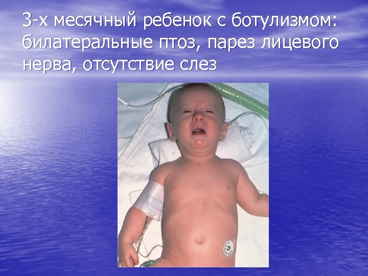 3 -х месячный ребенок с ботулизмом: билатеральные птоз, парез лицевого нерва, отсутствие слез 