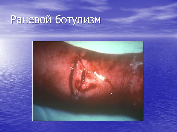 Раневой ботулизм 