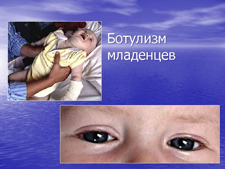 Ботулизм младенцев 