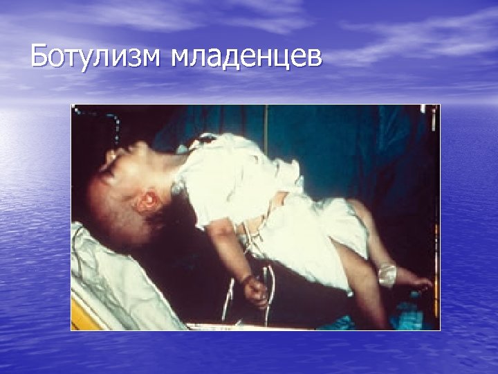 Ботулизм младенцев 