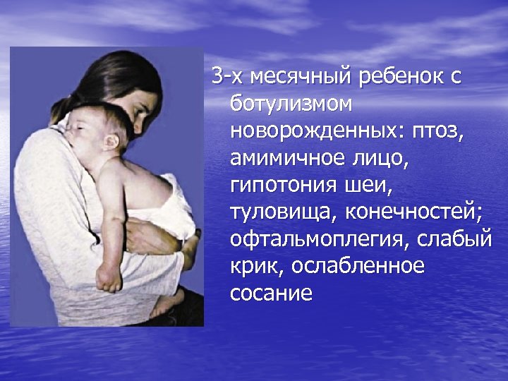 3 -х месячный ребенок с ботулизмом новорожденных: птоз, амимичное лицо, гипотония шеи, туловища, конечностей;