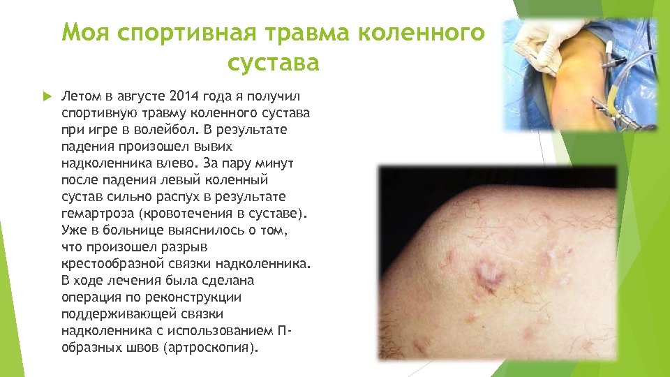 Моя спортивная травма коленного сустава Летом в августе 2014 года я получил спортивную травму