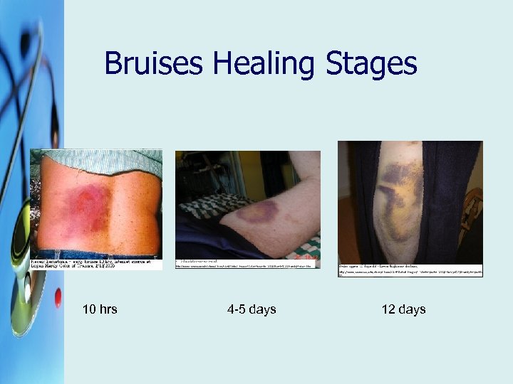 Bruises Healing Stages 10 hrs 4 -5 days 12 days 