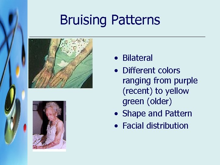 Bruising Patterns • Bilateral • Different colors ranging from purple (recent) to yellow green